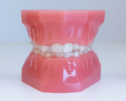 Aligneur invisible Orléans