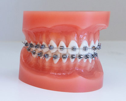 Orthodontie Bagues Orléans